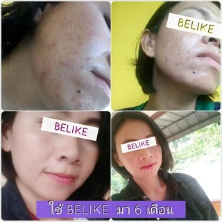 รับจากบริษัทโดยตรง 🌟 ครีม บีไล Belike บีไลค์ แก้ปัญหา สิว ฝ้า กระ หน้าหมองคล้ำ ขาว ไม่มีสารอันตราย