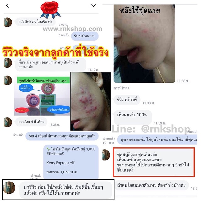 RNK set. 4 ชุดเข้มข้นพร้อมสบู่สิว สำหรับผิวที่เป็นสิวง่ายและมีผิวมัน จัดส่งฟรี รูปที่ 2