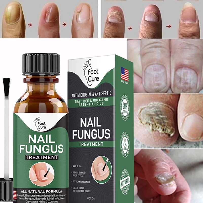 EXTRA STRONG Nail Fungus Treatment, Best Nail Repair, Stop Fungal Growth,  Effective Fingernail & Toenail Health Care Sol | Shopee Thailand