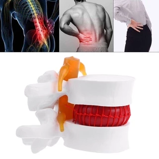 กายวิภาคของมนุษย์ Lumbar Disc Herniation Model การแพทย์ เรียนรู้ Aid Anatomy Instrume