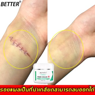 BETTER ครีมกำจัดรอยแผลเป็น 50ml ทำให้เนื้อเยื่อแผลเป็นนุ่ม เจลลดรอยแผลเป็น ครีมกำจัดรอยแผลเป็น ครีมลดรอยสิว