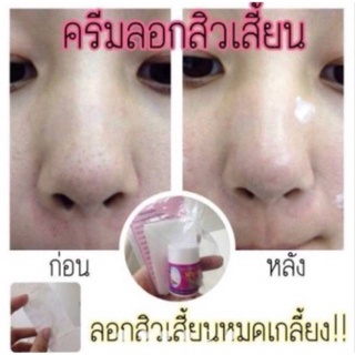 ของแท้❗️ ครีมลอกสิวเสี้ยน เวียดนาม