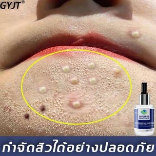 【ซื้อ 2 แถม 1 】เซรั่มลดสิว ครีมรักษาสิว 30ml (ครีมลดรอยสิว เจลลดสิว ครีมหน้าขาวใส สิวหายถาวร ครีมลดสิว ครีมแต้มสิว)