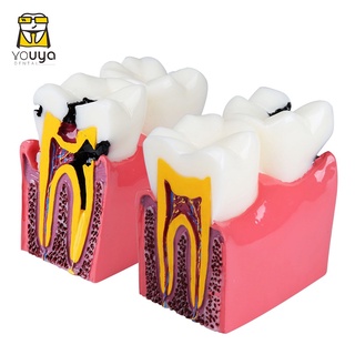 6x Dental Model Grinding Dental Pathology Anatomy Comparative Model Oral Cavity Model Teaching Model QBLF