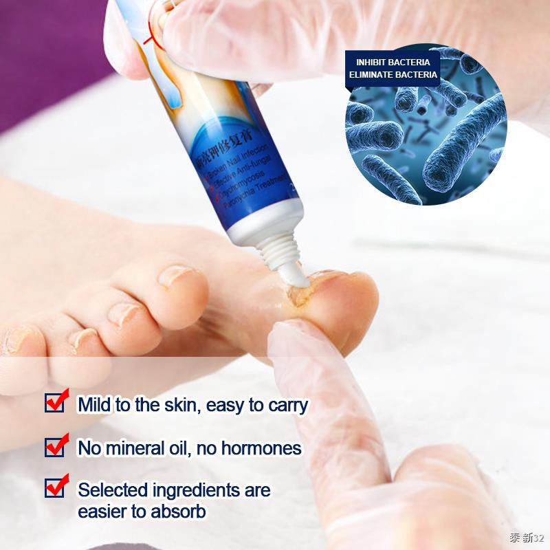 1pcs 20g Nail Fungus Ointment Treat Paronychia Onychomycosis Cream Toe