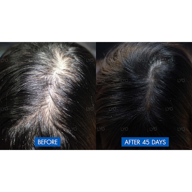 LYO ไลโอ หนุ่มกรรชัย #ส่งจากบริษัท  | ครบชุด แฮร์โทนิค แชมพู ครีมนวด lyo shampoo lyo hair tonic ช่วยลดผมร่วง - รูปที่ 7