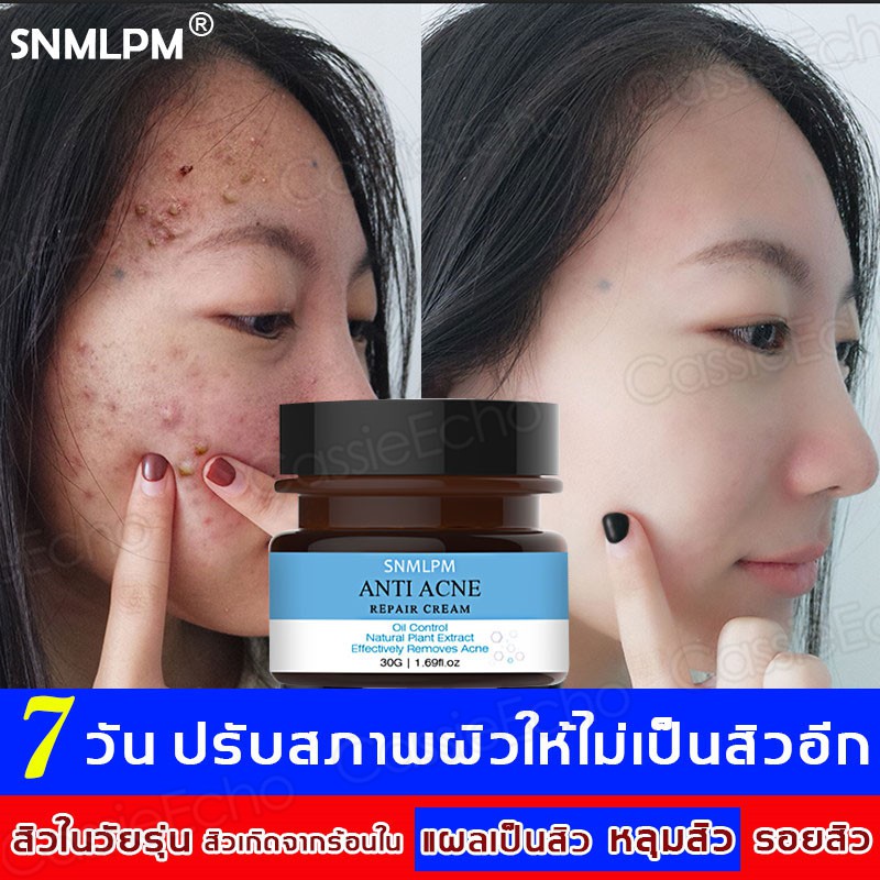 Snmlpmครีมกำจัดสิว ลอกสิวเสี้ยน ลดสิวอุดตันหัวปิด รักษาสิวอุดตันหัวปิด  ป้องกันสิว ผิวเรียบเนียน ครีมแต้มสิว ครีมรักษาสิว | Shopee Thailand