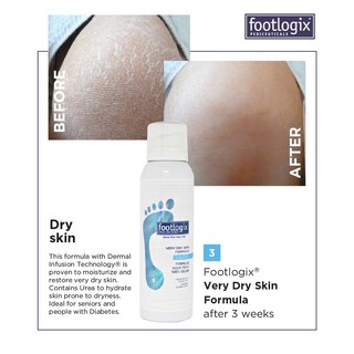 FOOTLOGIX มูสบำรุงเท้าแห้ง เท้าด้าน เป็นขุย เริ่มร้าว เนื้อมูสครีมซึมเร็ว เห็นผลทันที 1สัปดาห์very dry skin  #3 125 ml.