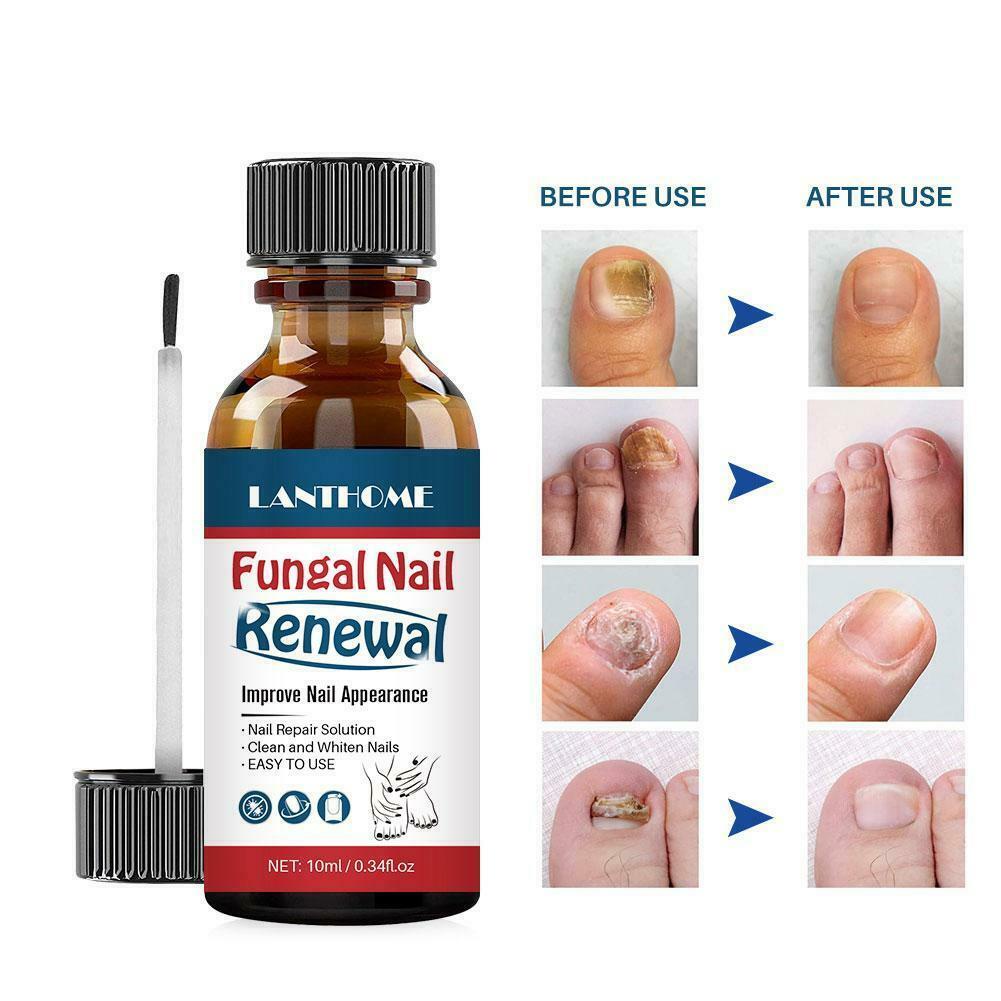 LANTHOME 10ml fungal nail repair nourish fungal nail to anti-infection hand treatment foot G9O6