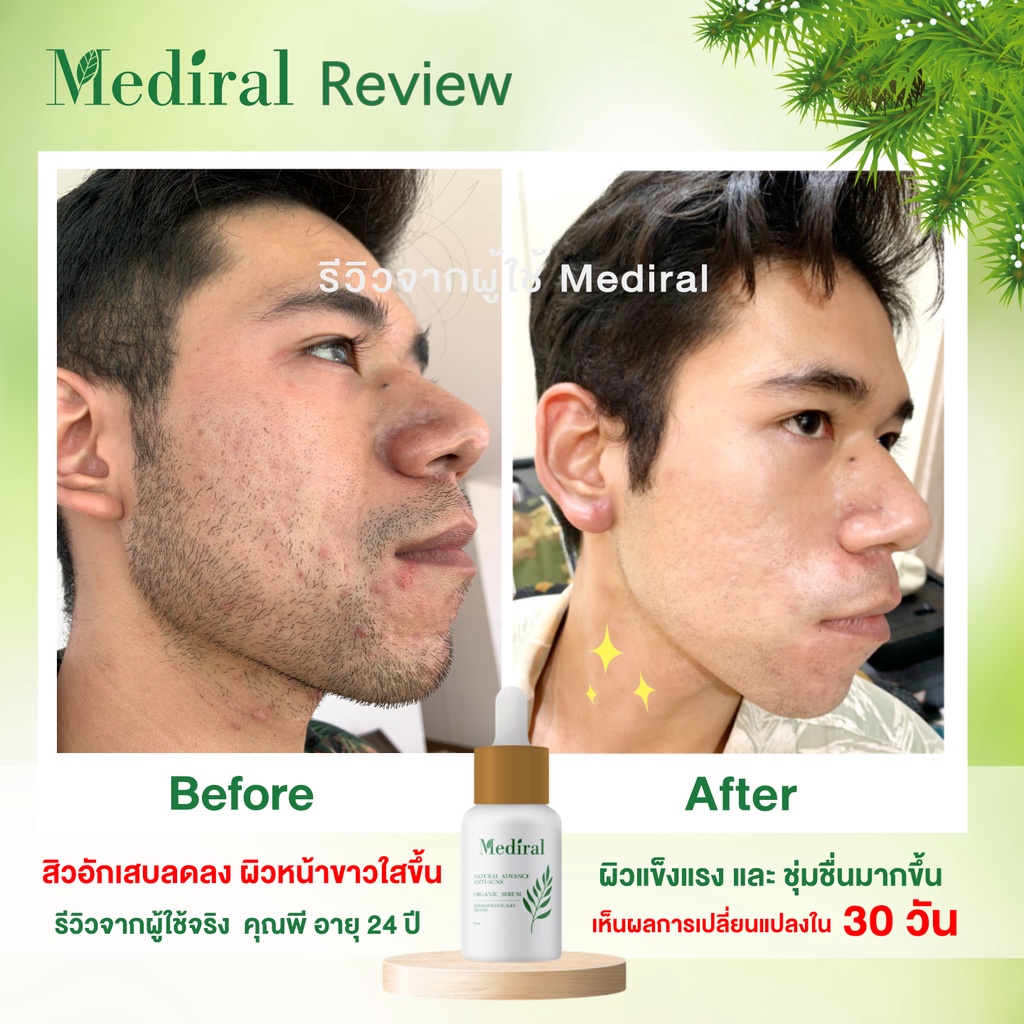 ของแท้ส่งฟรี!! Mediral เมดิรอล เซรั่มรักษาสิวสูตรคุณหมอ จบทุกปัญหาสิว ผิวอ่อนแอแพ้ง่าย เวชสำอางค์ที่แพทย์ผิวหนังแนะนำ