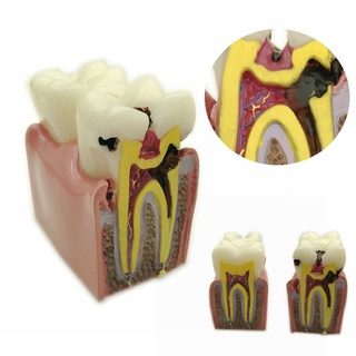 1pc Dental Anatomy Education Teeth Model 6 Times Caries Comparation Study Models