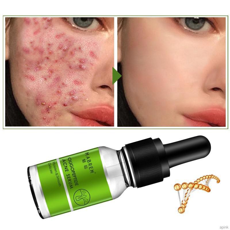 oligopeptide acne serum