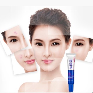 ครีมรักษาสิว เจลรักษาสิว Bioaqua Acne cream ไบโออควา ครีมลบสิว ครีมรักษารอยสิว เครื่องสำอางสำหรับผู้ที่เป็นสิว