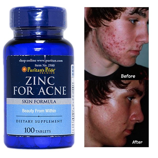 Zinc For Acne Puritan's Pride 100 Tablets