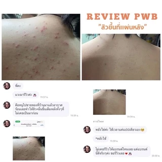 พร้อมส่ง ✨PWB ของแท้ 100%💕new packe💕ครีมบำรุงผิว ลดรอยแตกลาย รอยดำ รอยสิว รอยแผล มีบัตรตัวแทน