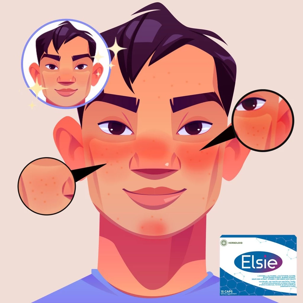 ELSIE ผลิตภัณฑ์ฟื้นฟูสุขภาพผิวหนัง และบรรเทาสะเก็ดเงิน - 6 แถม 3 thumbnail 6