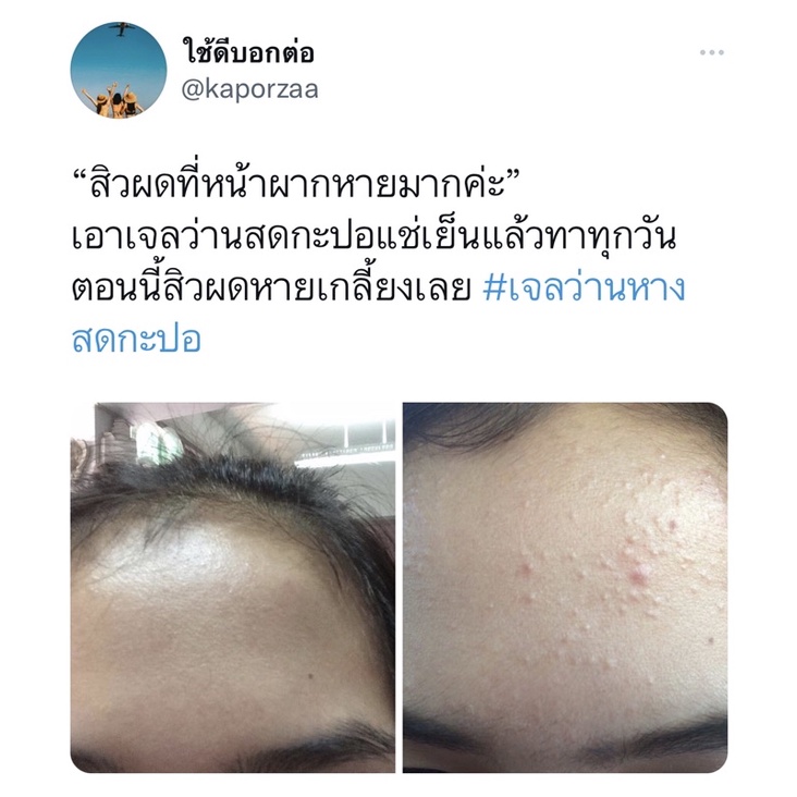 KAPOR เจลว่านหางจระเข้ สูตรลดสิว ลดรอย ฟื้นฟูผิวติดสาร