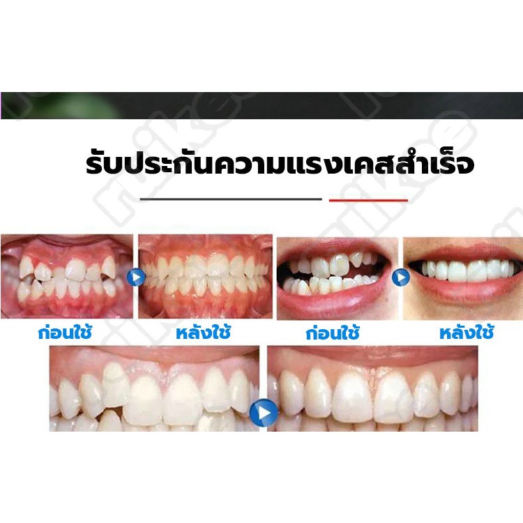 ที่มองไม่เห็นฟันทันตกรรมจัดฟันเฟสการจัดฟันที่มองไม่เห็น 4 มิติจัดฟันเอง ...
