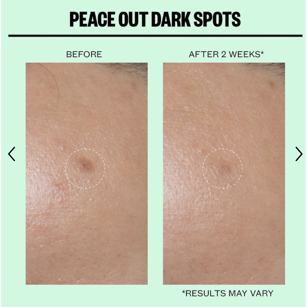 peace-out-acne-dark-spots-acne-dark-spots-bossbabe