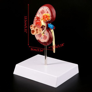 Life Size Human Kidney Diseased Model Anatomical Anatomy Diseased Pathological Stone Organ U2LB