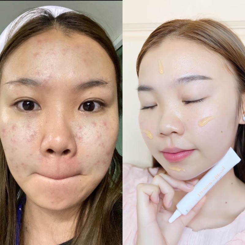 พร้อมส่ง️เจลมังกร(ลดรอยดำแดงหลุมสิว) bai.bai.official ThaiPick