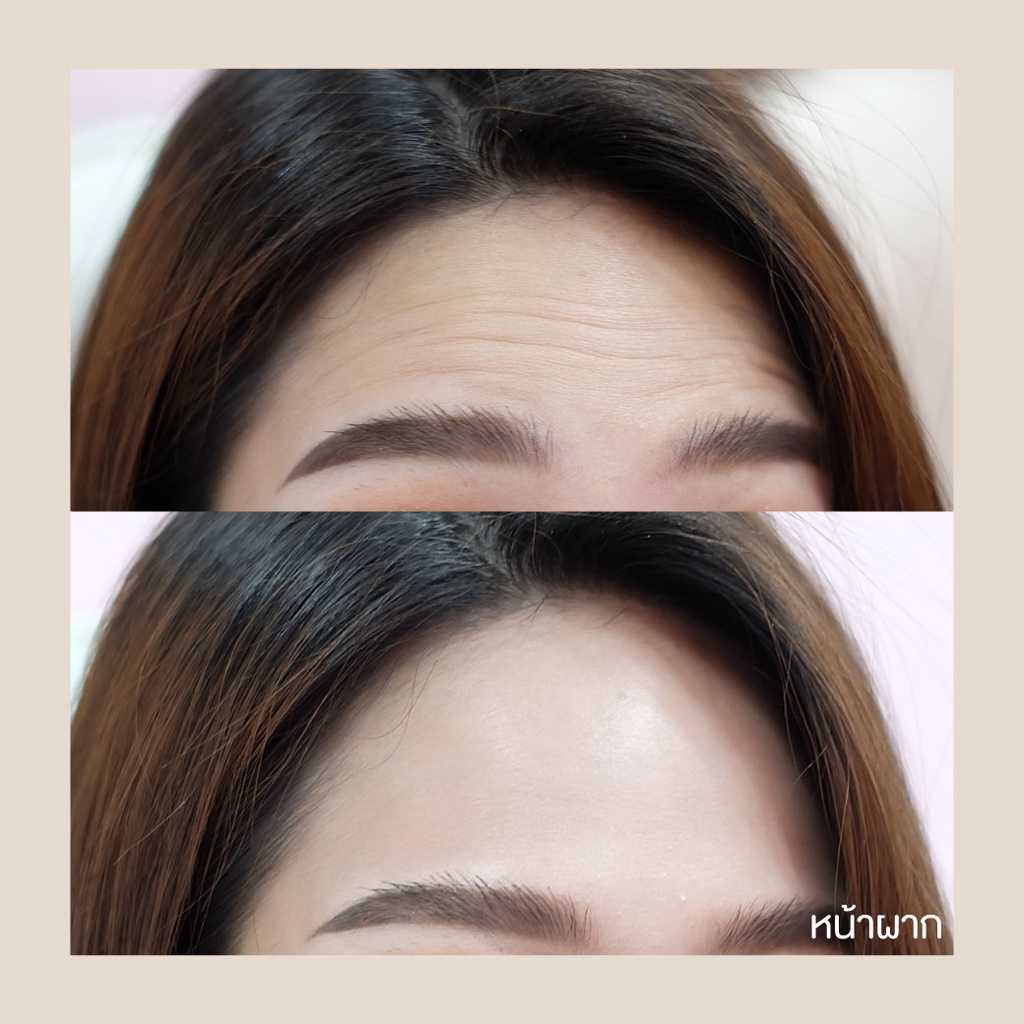 Botox (Nabota) Wrinkles or Jawline or Face Lift / ริ้วรอย หรือ กราม หรือ ลิฟหน้า โบท็อกเกาหลียี้ห้อเดียวที่ได้ US FDA