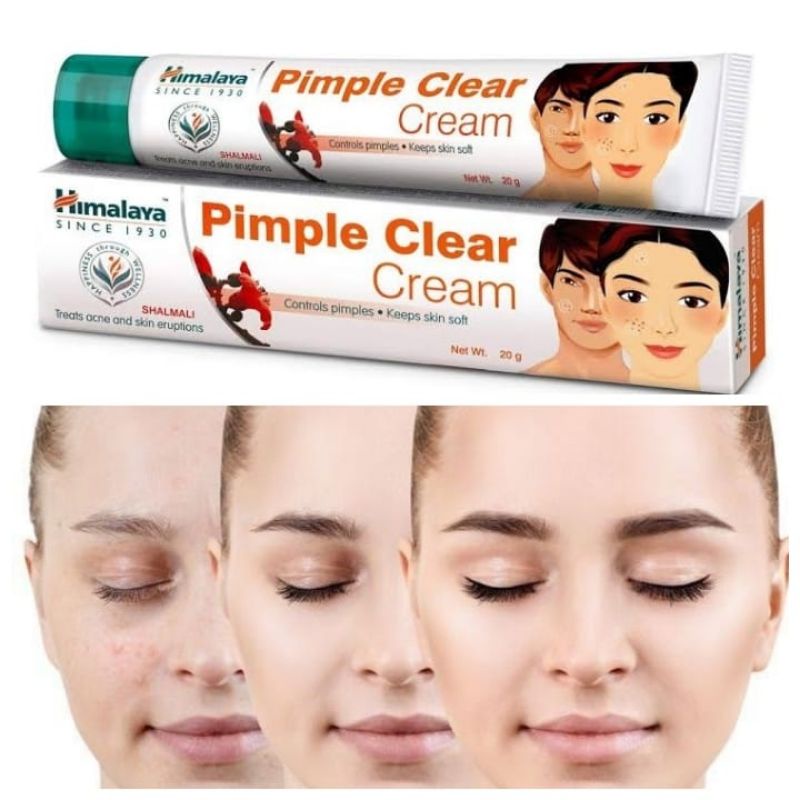 Himalaya pimple cream ครีมรักษาสิว 20กรัม