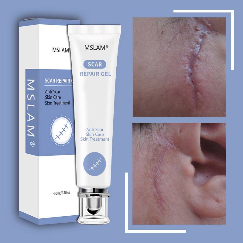 ข ้ อเสนอพิเศษ!Mslam Scar Repair Gel Removal Scar Acne Cream Treatment Marks สําหรับ Face Body Pigmentation Corrector Skin Care