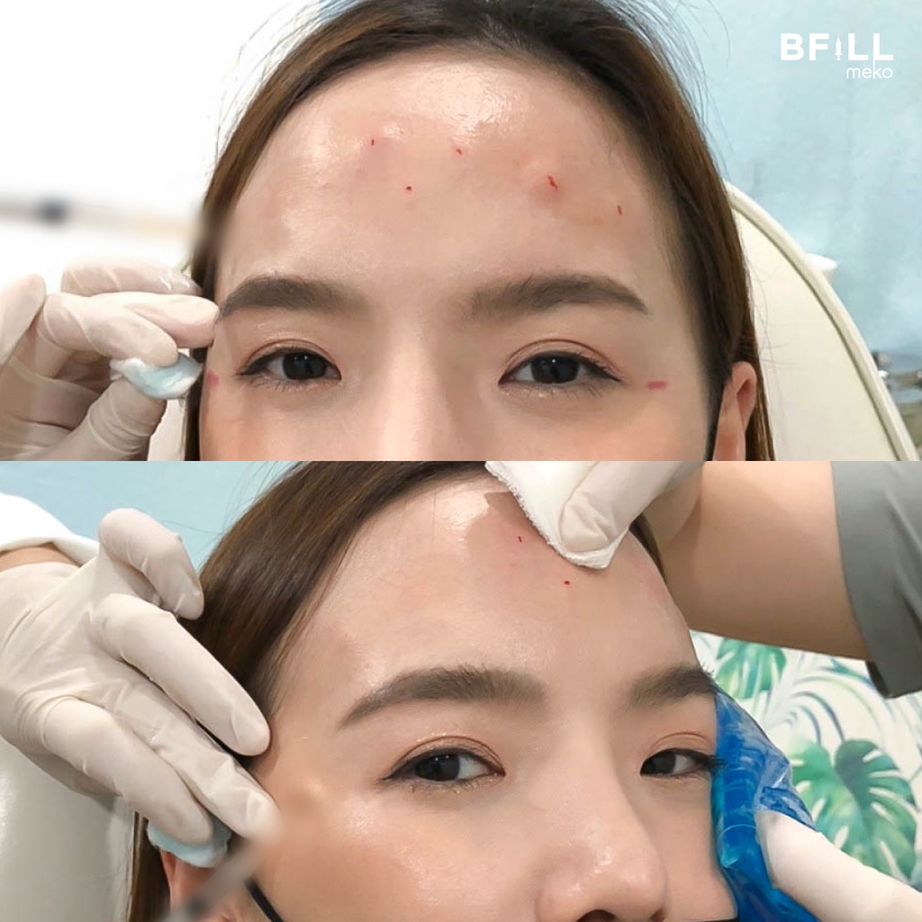 Botox (Aestox) Wrinkles โบท็อก ริ้วรอย ตีนกา หว่างคิ้ว ริ้วรอยหน้าผาก โบปีกจมูก