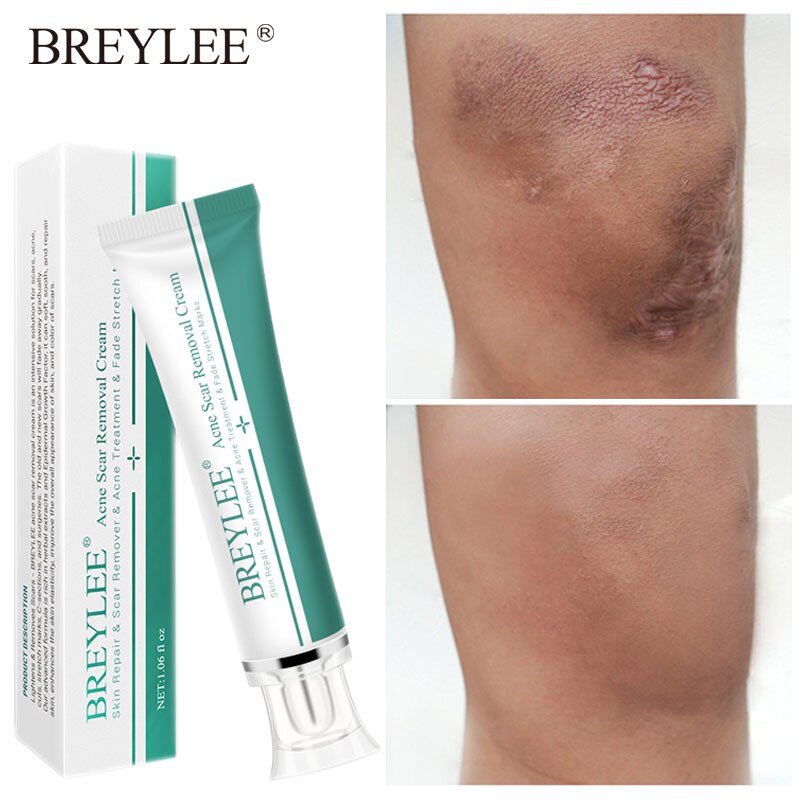 breylee scar removal cream