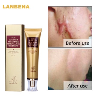 Acne Scar Removal Cream Skin Repair Face Cream Acne Spots Acne Treatment Blackhead Whitening Cream Stretch Marks 30ml