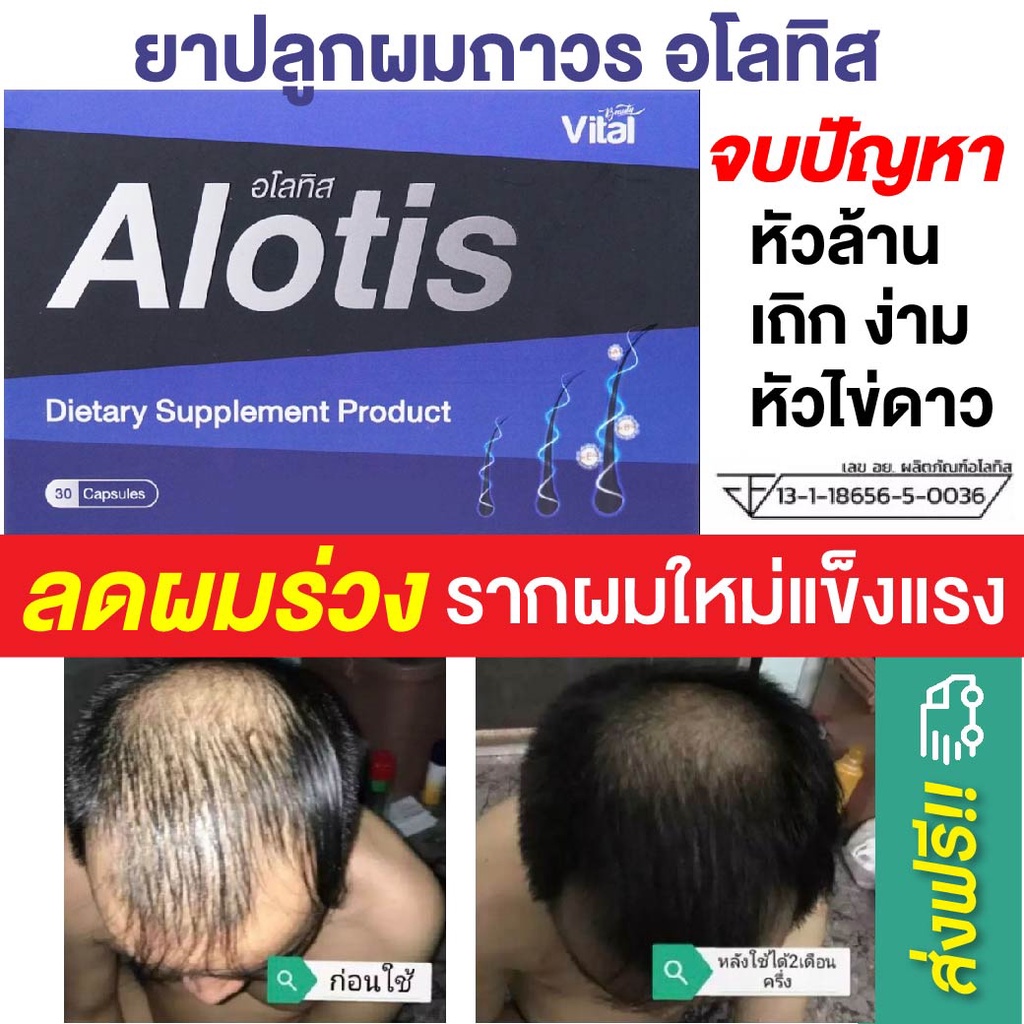 ยาปลูกผม Alotis อโลทิส ปลูกผม ลดผมร่วง ลดผมบาง หัวล้าน หัวเถิกไข่ดาว รากผมแข็งแรง เห็นผลจริง มีรีวิว