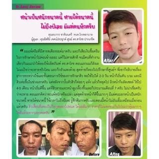 ดร.สาโรช เฮอร์เบิล แอคเน่เคลียร์ โลชั่น (โลชั่นสิว) สำหรับสิวอุดตัน สิวอักเสบ ส่งฟรี