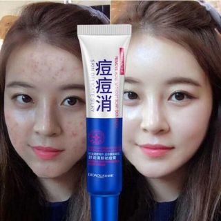 🚒พร้อมส่ง👉🏻ครีมรักษาสิว เจลรักษาสิว​ ครีมแต้มสิว ครีมลบสิว ครีมรักษารอยสิว​ Acne Treatment Cream Anti Acne Scar