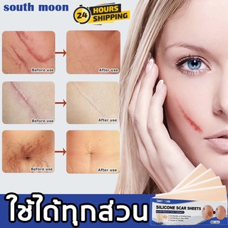 【จัดส่งจากกรุงเทพฯ】South Moon แผ่นแปะรอยแผลเป็น เจลลบรอยแผลเป็น 4แผ่น/กล่อง ลบรอยแผลเป็นแผลผ่าตัด น้ำร้อนลวก