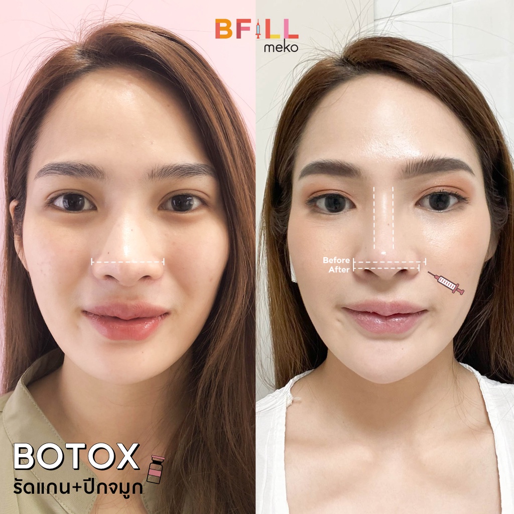 Botox (Aestox) Wrinkles โบท็อก ริ้วรอย ตีนกา หว่างคิ้ว ริ้วรอยหน้าผาก โบปีกจมูก