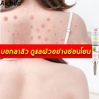 aichun ครีมแต้มสิว 30ml  บอกลาหลุมสิว รอยแดง บวม ซึมไว  ให้สิวจางลง（เซรั่มกำจัดสิว ครีมกำจัดสิว เซรั่มลดสิ)  Acne cream