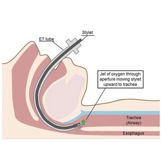 ไกด์ เอ็นโด GUIDES ENDOTRACHEAL TUBE Guide wire (Stylet) ตัวช่วยนำในการใส่ท่อช่วยหายใจ for endotracheal tube ขดลวดนำ