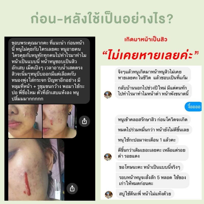 KAPOR เจลว่านหางจระเข้ สูตรลดสิว ลดรอย ฟื้นฟูผิวติดสาร