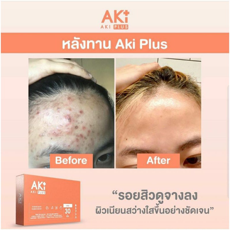 Aki Plus วิตามินลดสิวผิวใสสูตรเข้มข้น คืนความเรียบเนียนฉ่ำวาวให้ผิว ...