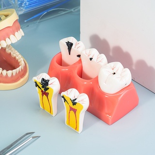 Dental Anatomy Education Teeth Model 4 Times Caries Comparation Study Models SNAI