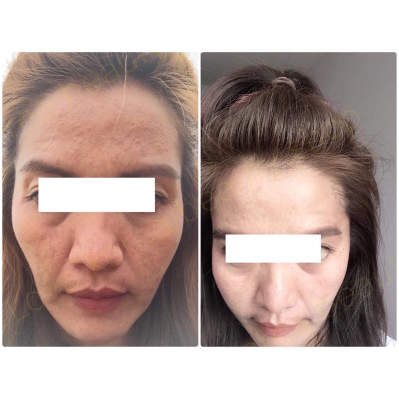 💧การจัดส่งที่รวดเร็ว💧 BOTOXแบบทา‼️[โค้ดBYMWPBXU  ลด 160 บาท] ร้านนี้ส่งฟรี🔥 เมื่อการฉีดมันล้าสมัยไปแ