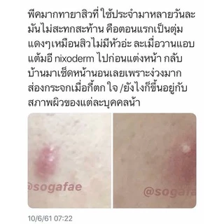 Nixoderm ครีมรักษาสิว สิว สิวอักเสบ สิวอุดตัน สิวผด ผื่น กลากเกลื้อน อาการคัน เชื้อรา บรรเทาอาการคันตามผิวหนัง ผลิต07/21
