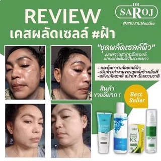 ดร.สาโรช ไฮโกล โลชั่น รักษาฝ้า สำหรับ หน้ามันมาก x2 Hi glow