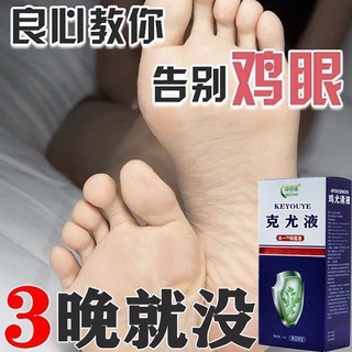 ครีมข้าวโพด [One Drop Painless Fall off] กําจัดข้าวโพดเท้า มือ ข้าวโพด นิ้วเท้า ฝ่าเท้า แคลลัส เนื้อไก่ ยูจีนิก โปรโมชั่นผลิตภัณฑ์สดใหม่