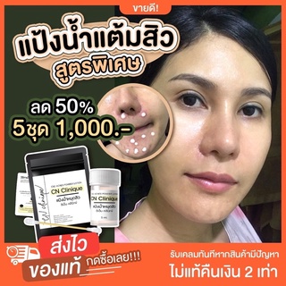 แป้งน้ำเเต้มสิว ชุดสุดคุ้ม ของแท้