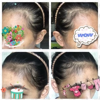 📣Witch Hair เซรั่มปลูกผม คิ้ว หนวด ขวดแรกเห็นผล💯% ขนาด 60ml.