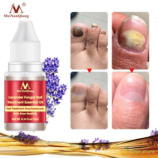 ♡♥♡ 10ml Nail Fungus Treatment Anti Fungal Toenail Repair Care Lavender Essential Oil