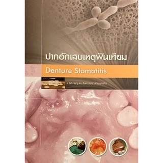 (ศูนย์หนังสือจุฬาฯ) ปากอักเสบเหตุฟันเทียม (DENTURE STOMATITIS) (9786163355218)