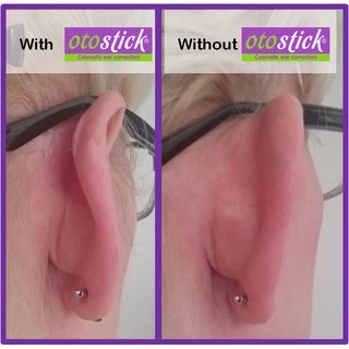 🔥แก้หูกาง🔥 OTOSTICK 2 แพ็ค แบบเนียนเป็นธรรมชาติสุด ยกกล่อง ล็อตใหม่ล่าสุด ฟรีแผ่นแอลกอฮอล์